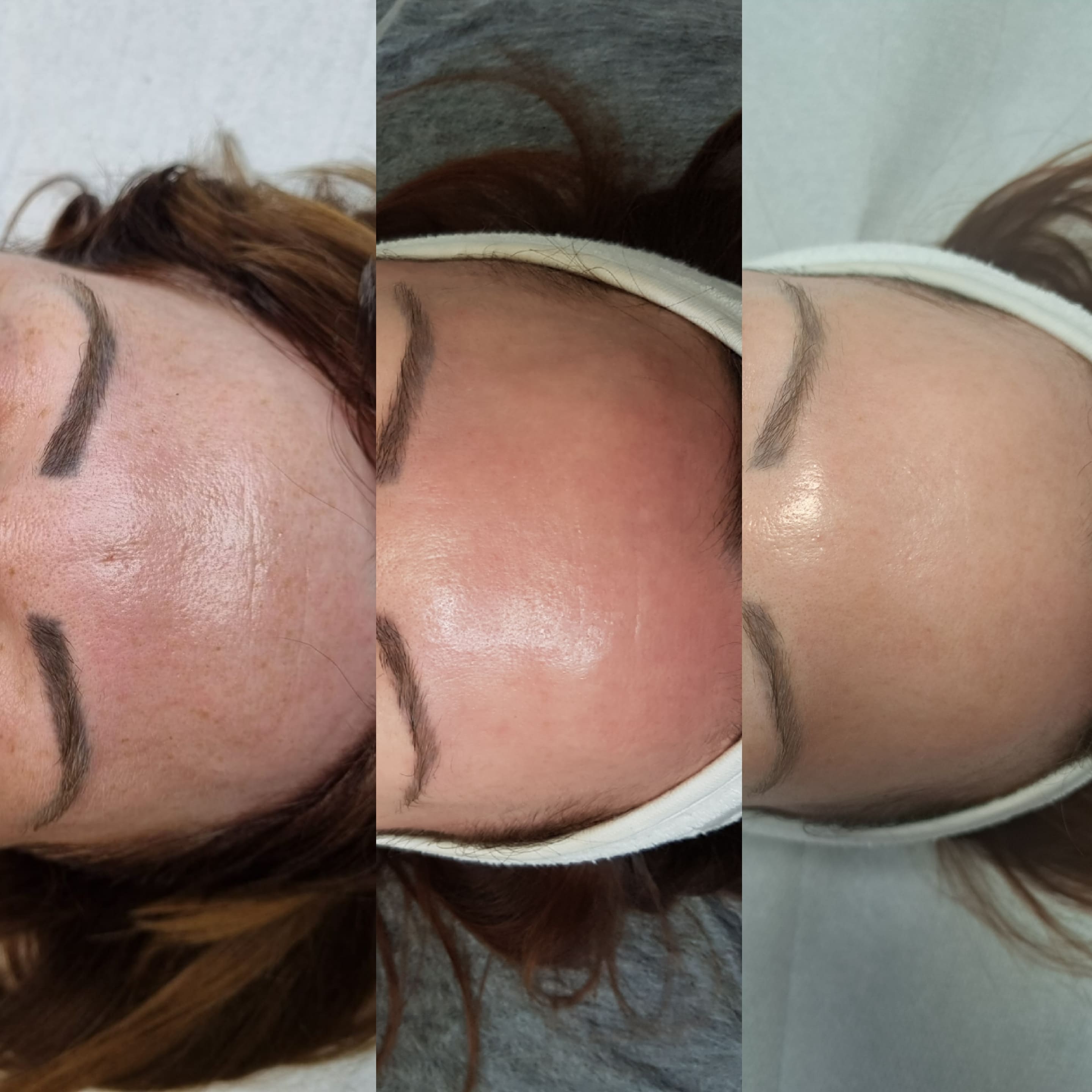 EstGen leszczenko_efekty_szczecin_antyage_fotodynamika