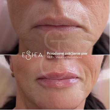 Porovnanie pred a po omladení tváre a pier kyselinou hyalurónovou – rozžiarená a hydratovaná pleť