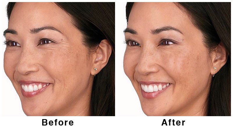 Before and after of surgery image