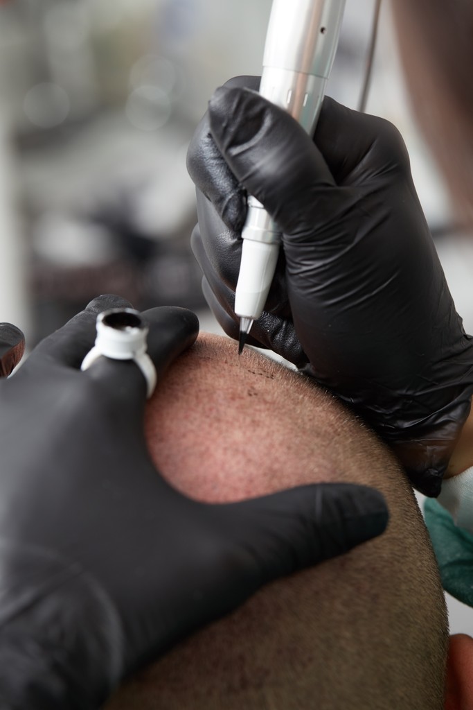 SMP Being applied to male scalp