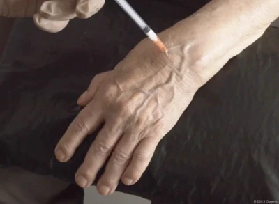 Wrist joint injection (radiocarpal joint)