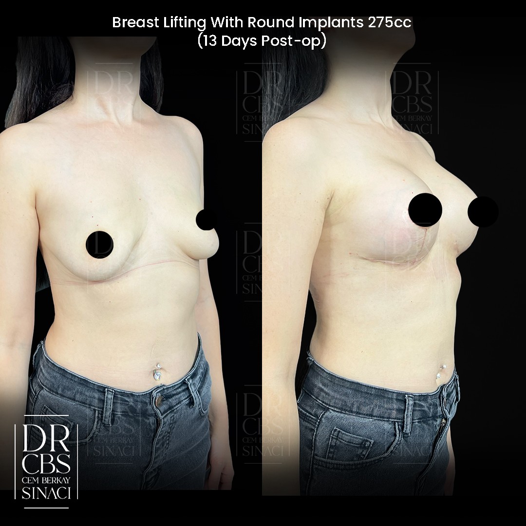 13 days before after breast lift with implant in Turkey oblique view