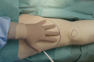 Above knee amputation