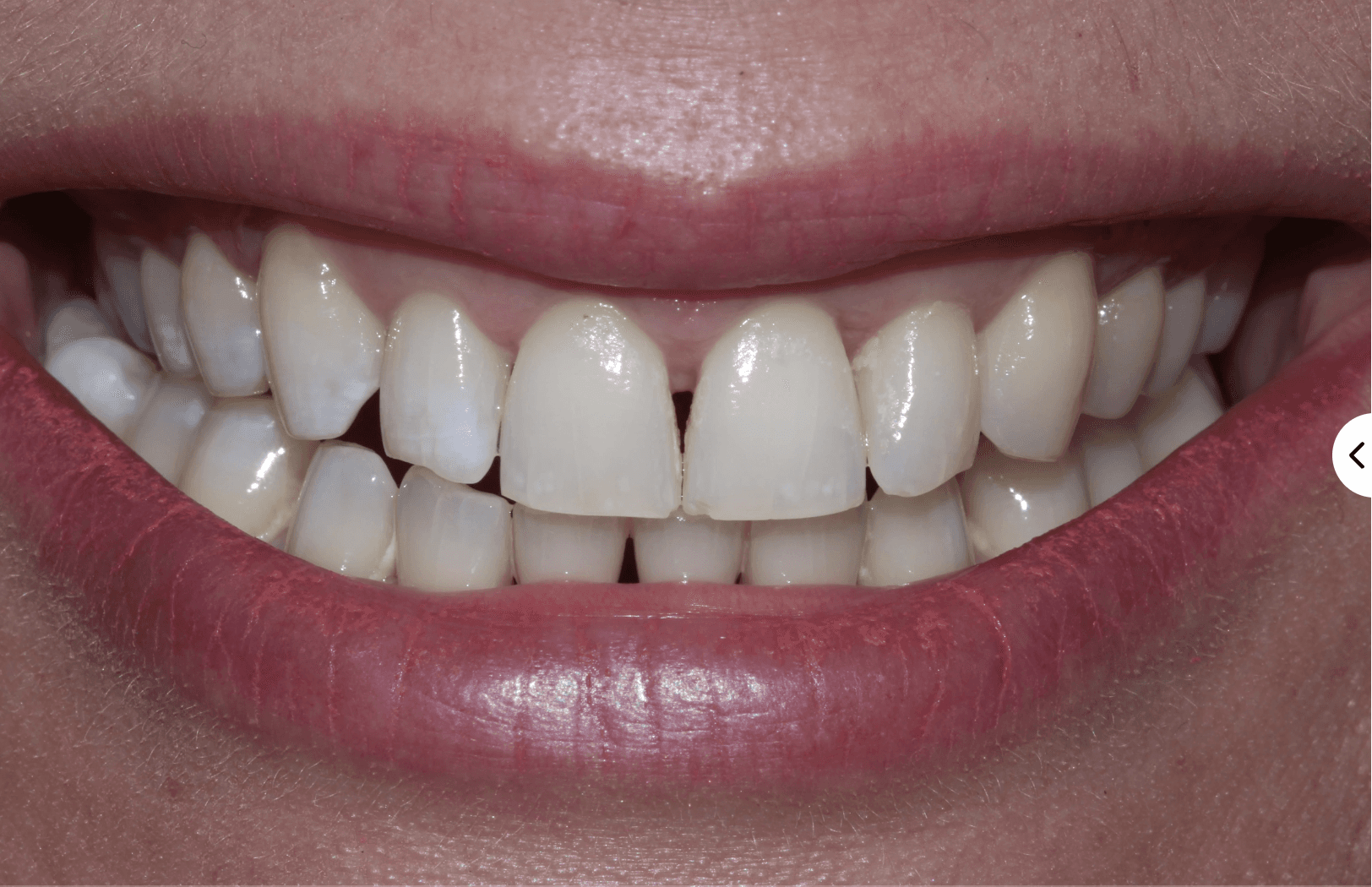 Gaps in teeth that look like black triangles before Bioclear treatment