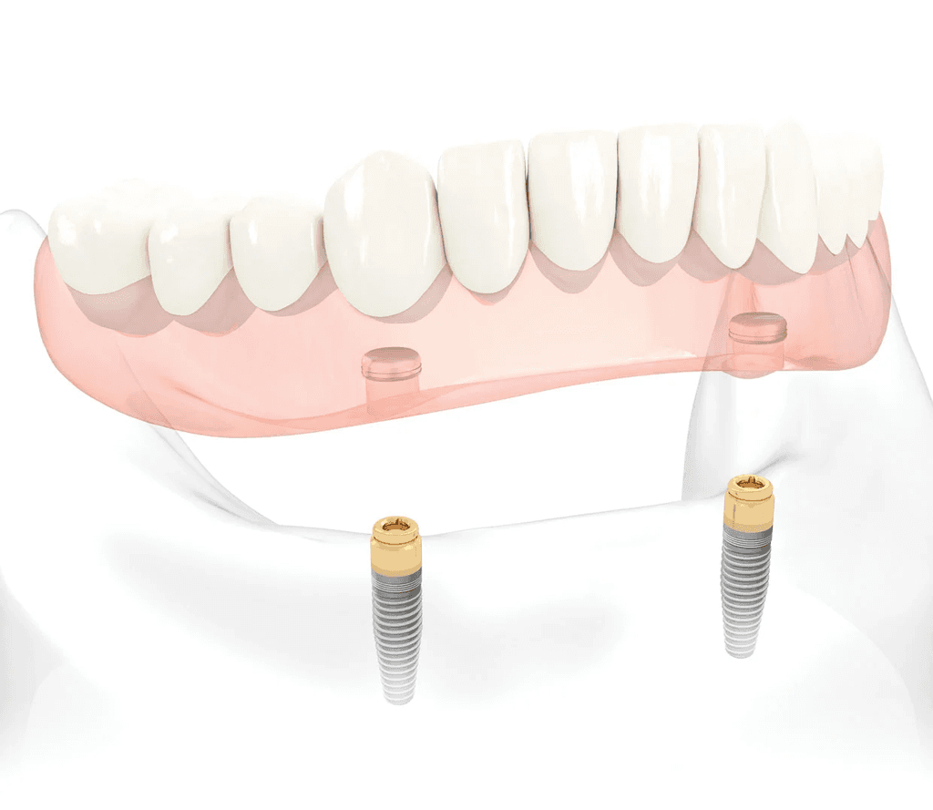 dentures technique