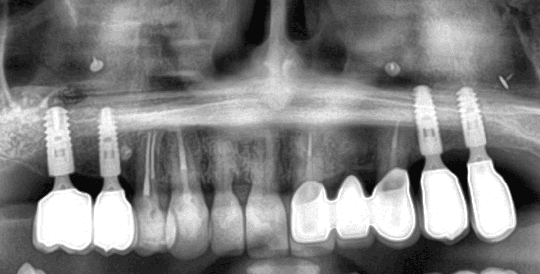 RTG snímka keramického mostíka a implantátov