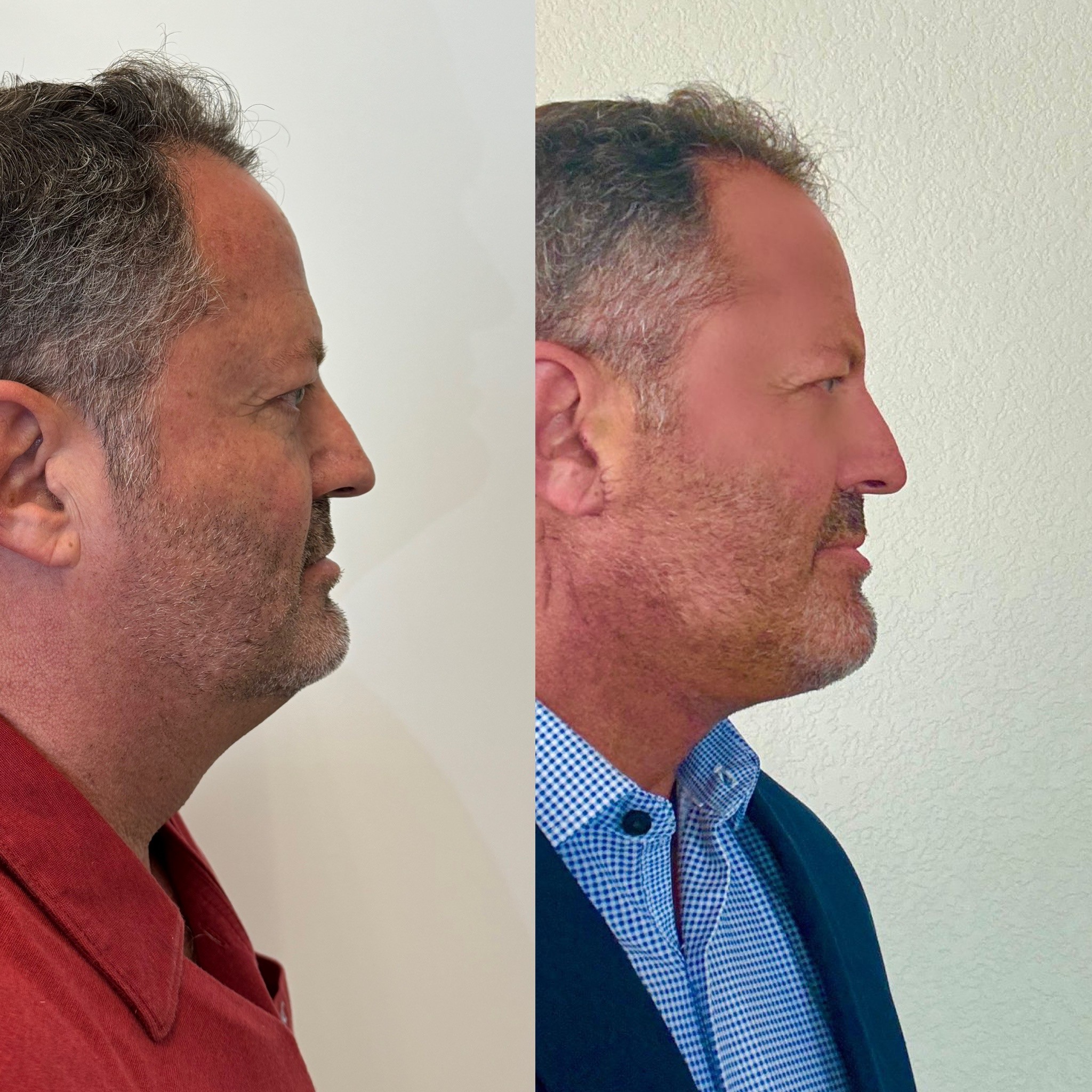 neck lift for turkey neck deformity before after right side view