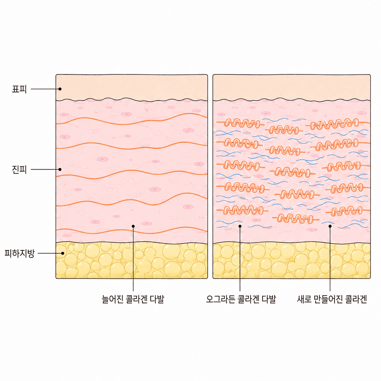 늘어진 다발이 오그라들고, 그 뒤에 새 콜라겐이 채워져요.