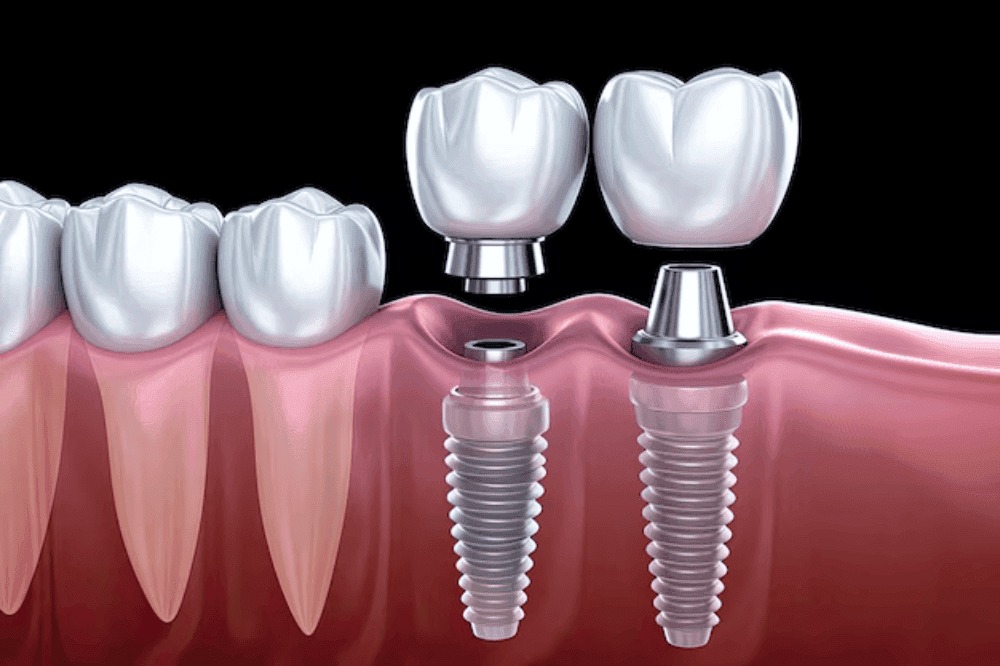veneers
