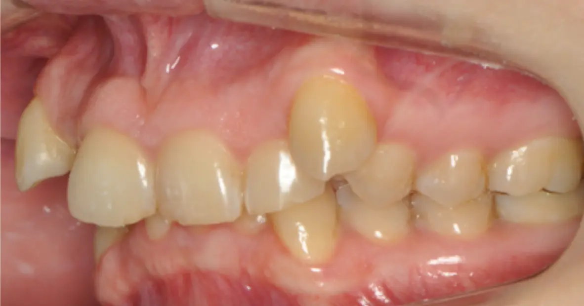 Prima e dopo il trattamento ortodontico funzionale, senza estrazione dei denti premolari