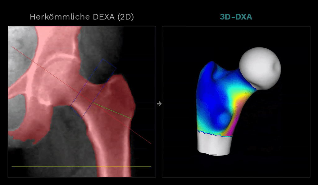 Vergleich herkömmliche 2D-DEXA-Aufnahme eines Hüftknochens und dreidimensionales 3D-DXA-Modell mit farbcodierter Knochendichtedarstellung bei DexaLife