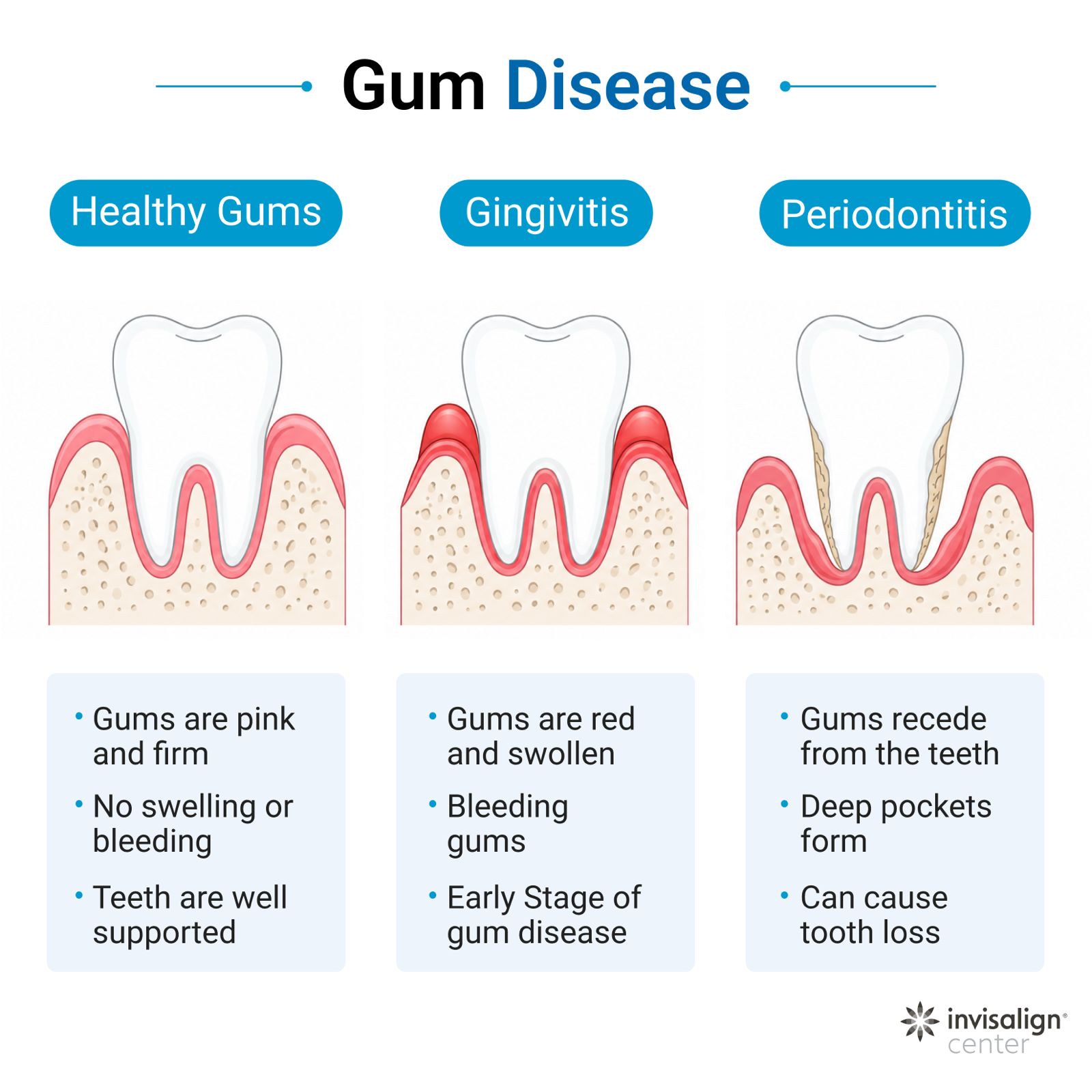Progression of gum disease from healthy gums to gingivitis and periodontitis.