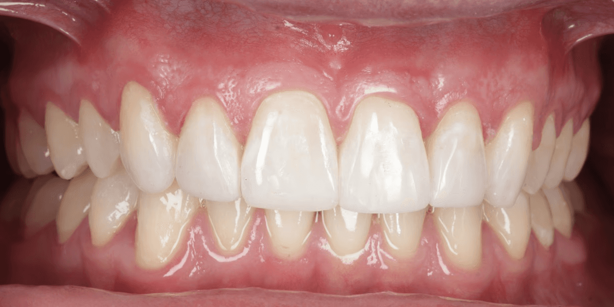 After clear aligner treatment showing upper and lower teeth
