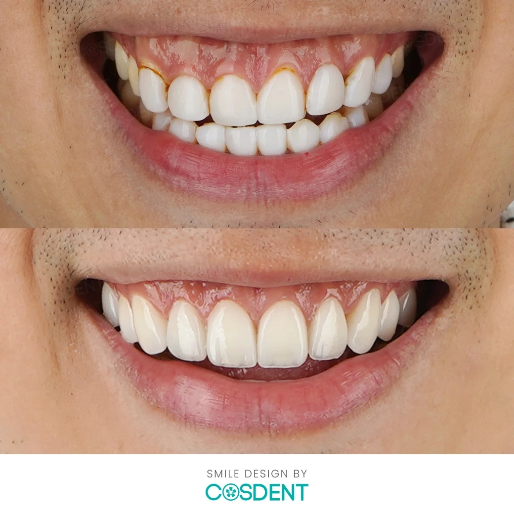 รีวิวออกแบบรอยยิ้ม ที่ cosdent smile design