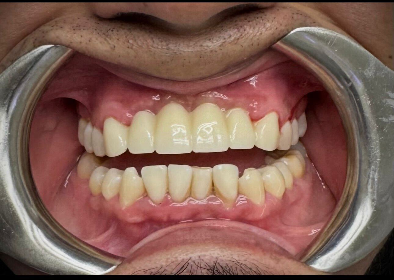 SMile transformation before and after image