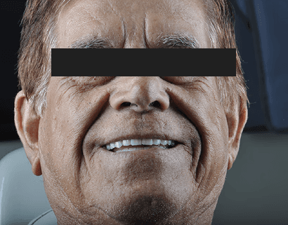 Imagem clínica de sorriso de paciente adulto, com identidade preservada para fins ilustrativos