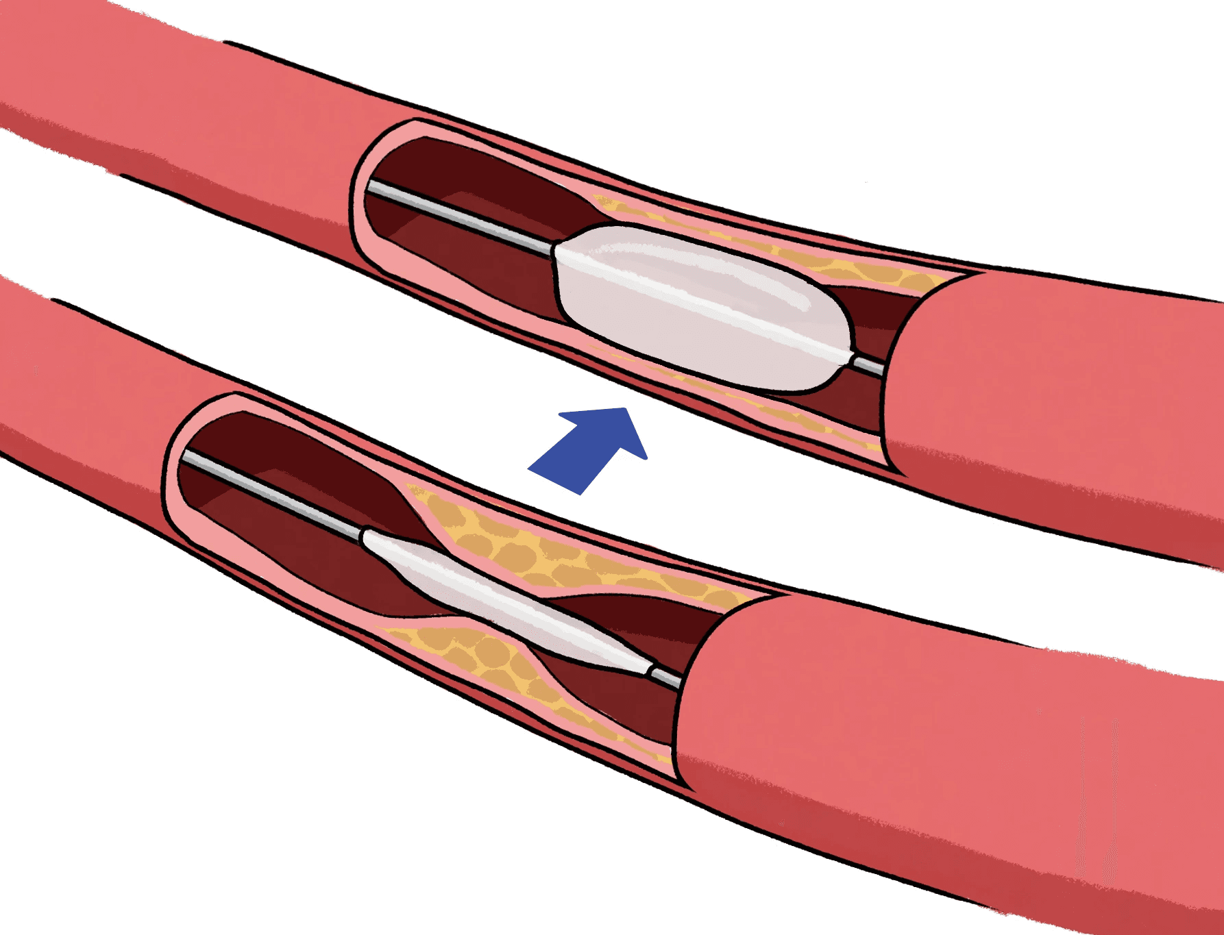 풍선확장술 일러스트