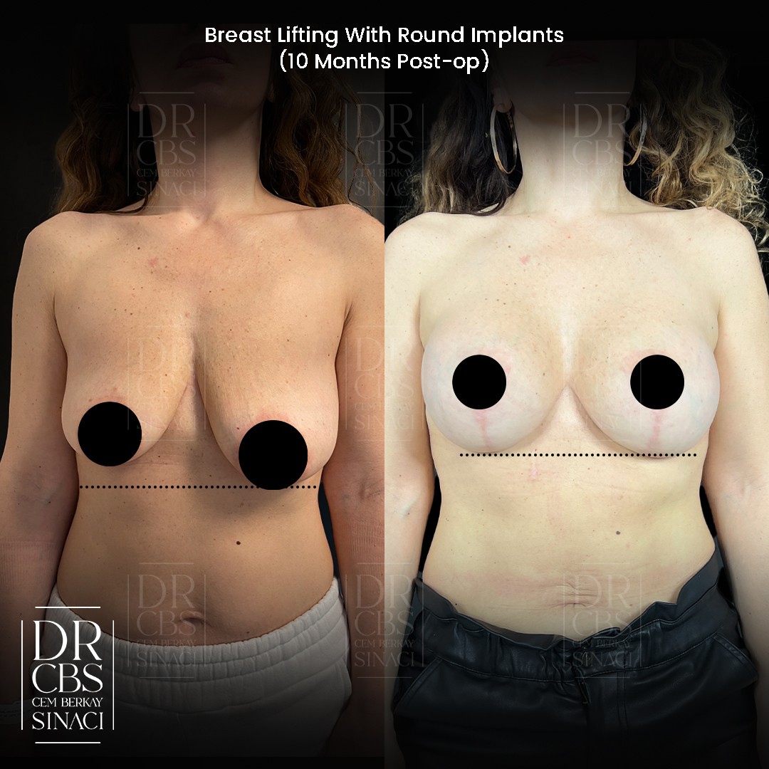 10 months before after breast lift with implant in Istanbul Turkey front view