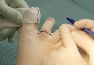 Toe amputation