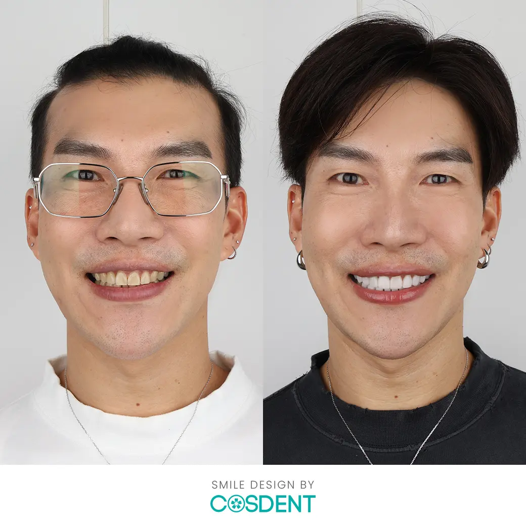 เคสทำวีเนียร์ หมอเช็ค cosdent smile design