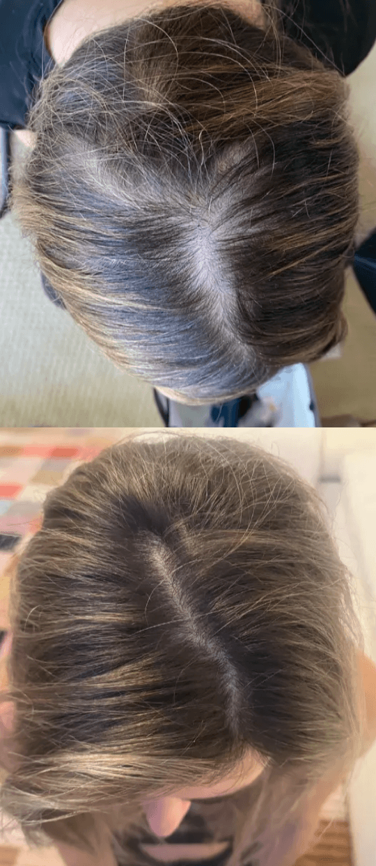 minoxidil works to treat female hair thinning