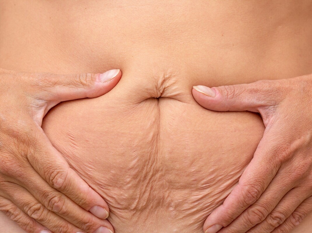 loose skin after weight loss