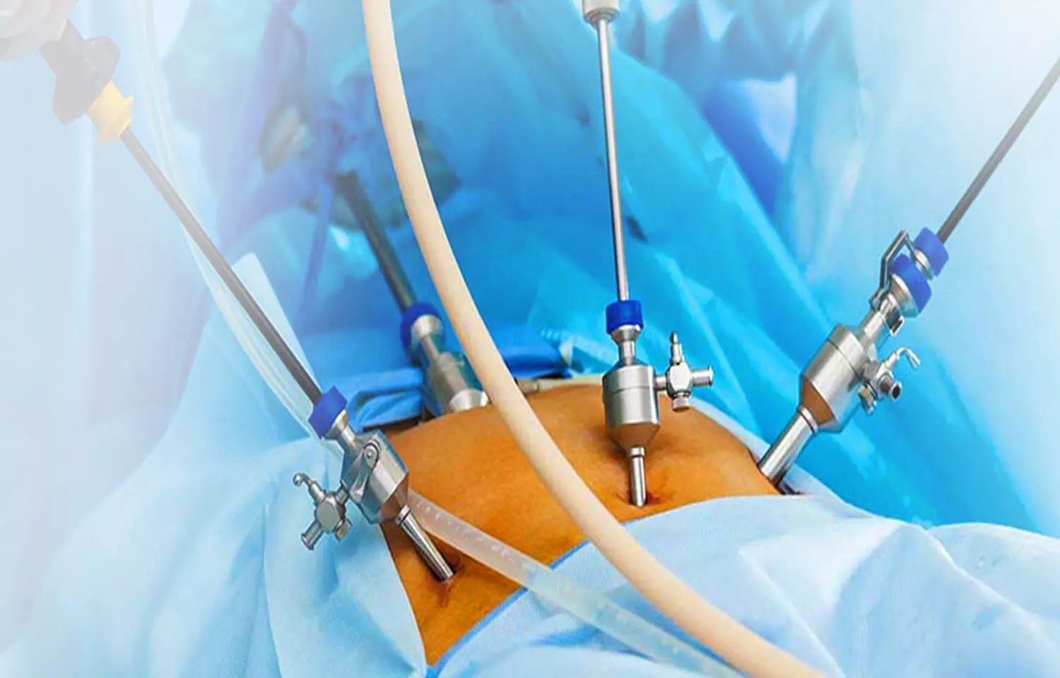 Laparoscopic Surgery