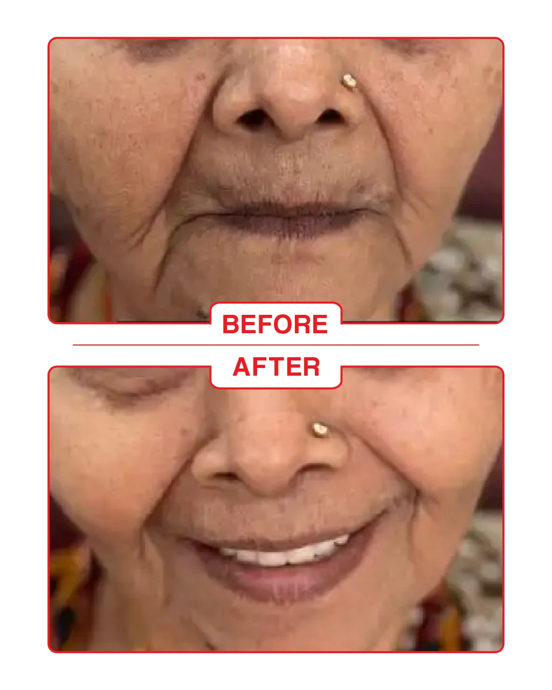 Before and after dental scaling