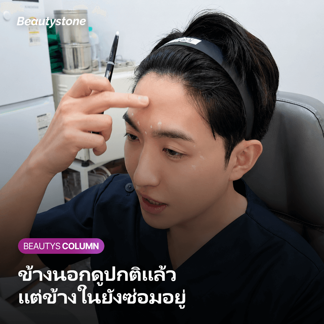 ภาพแสดงชั้นหนังแท้ที่ได้รับความร้อนและกำลังอยู่ในช่วงซ่อมสร้างคอลลาเจนใหม่