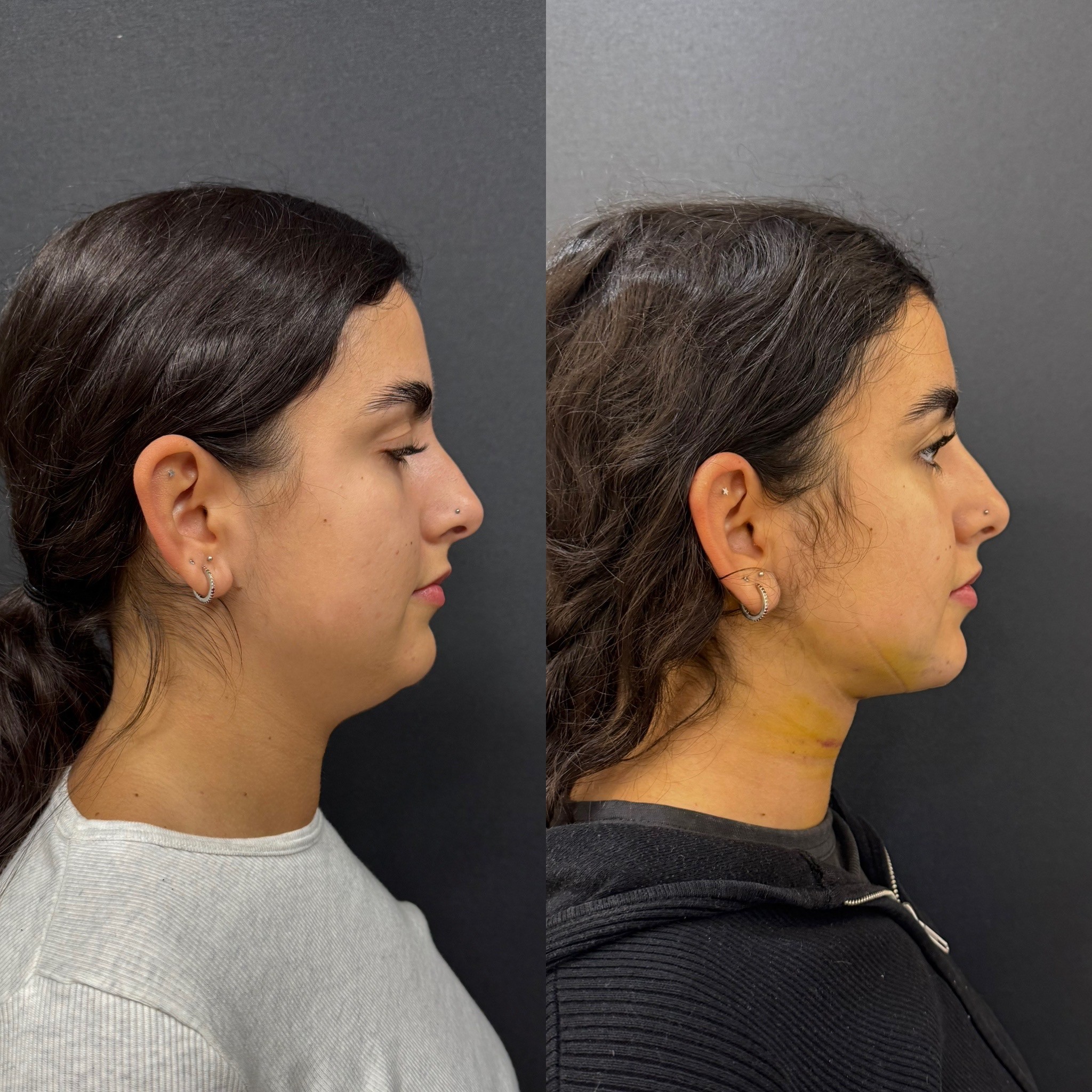 double chin laser liposuction before after 4 days post-op left side view