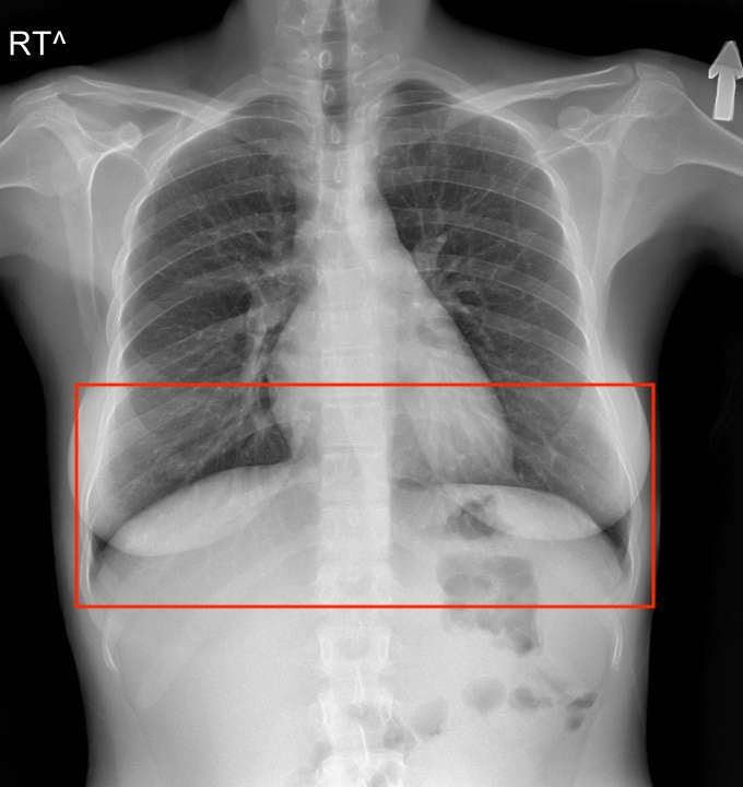 Chest X-ray