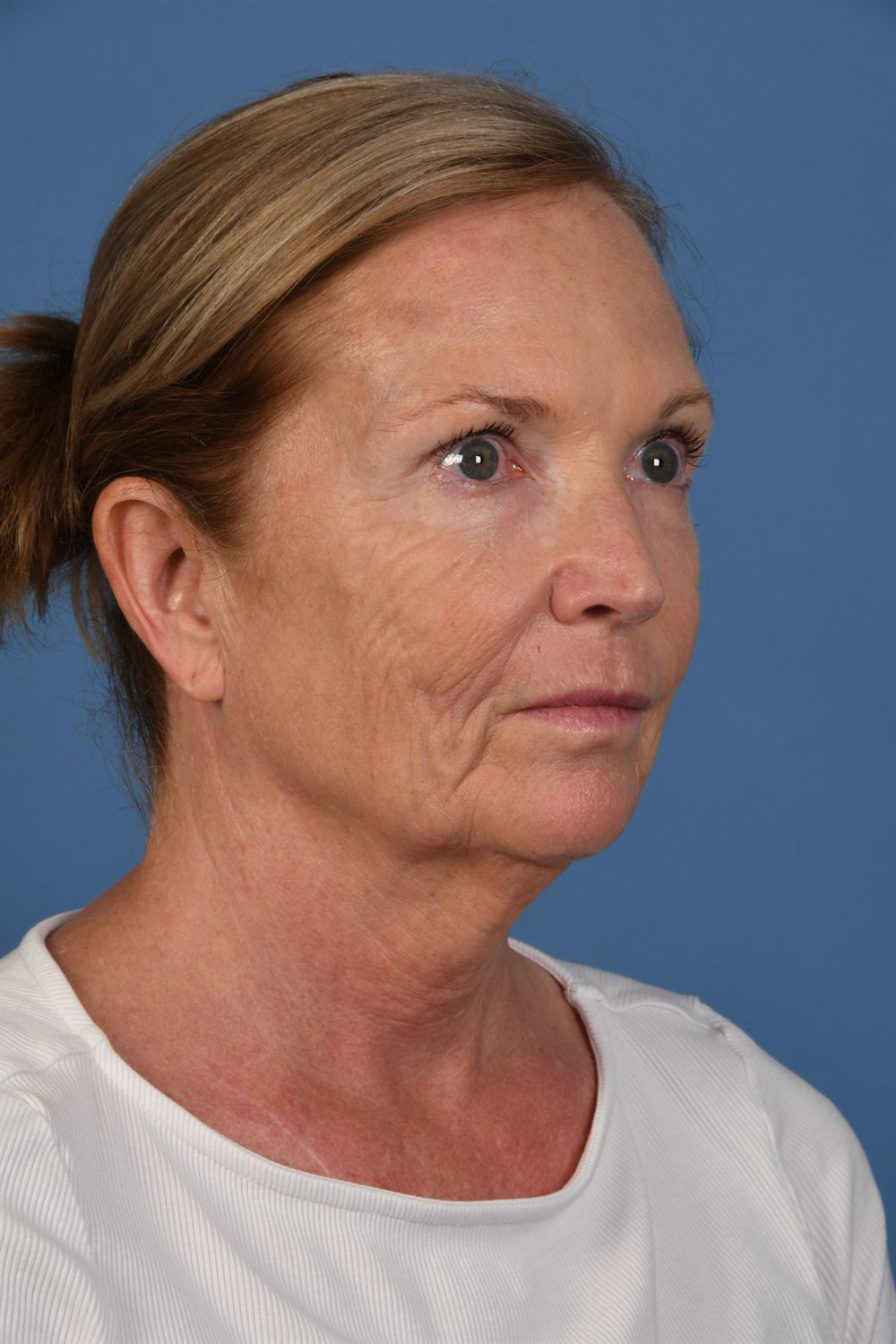 Facelift patient before surgery, three-quarter view, right side