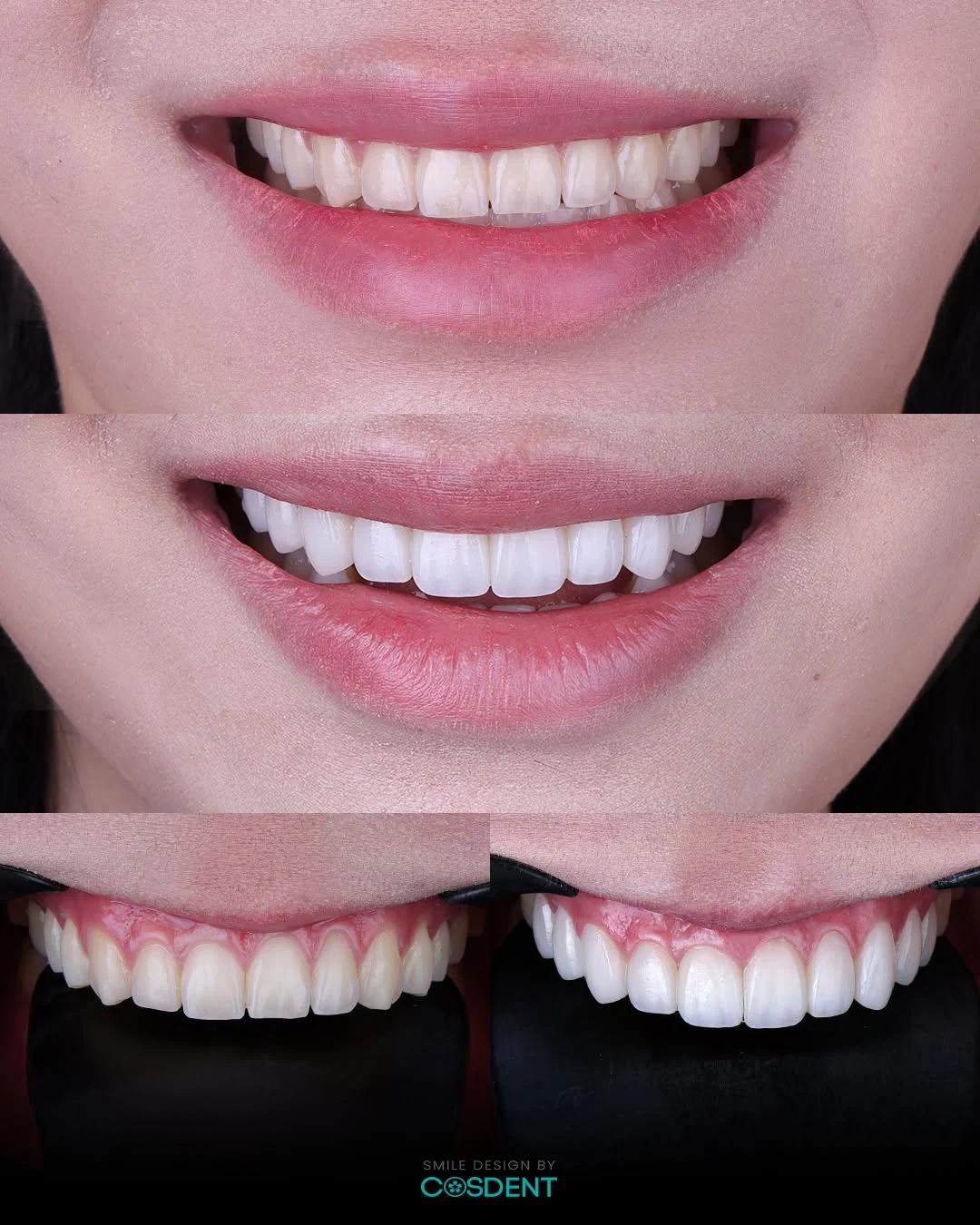 Smile photographs and close-up views comparing the appearance of upper front teeth.