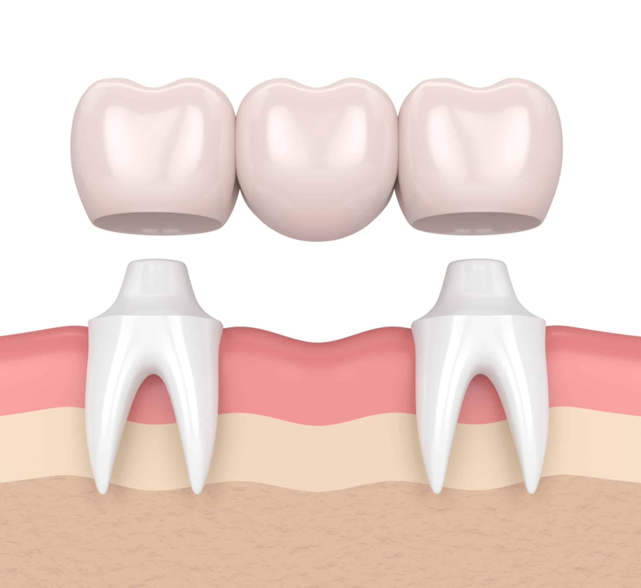 dental bridges