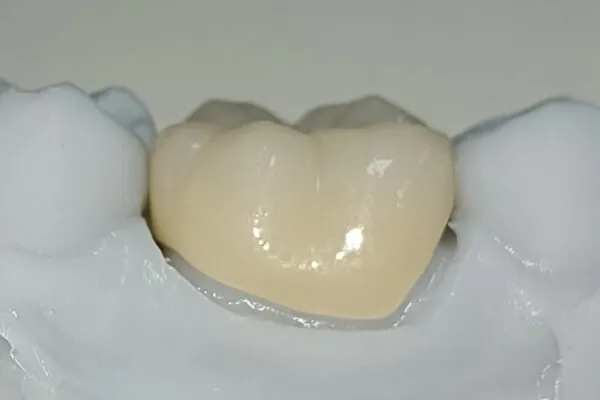 same-day dental crowns