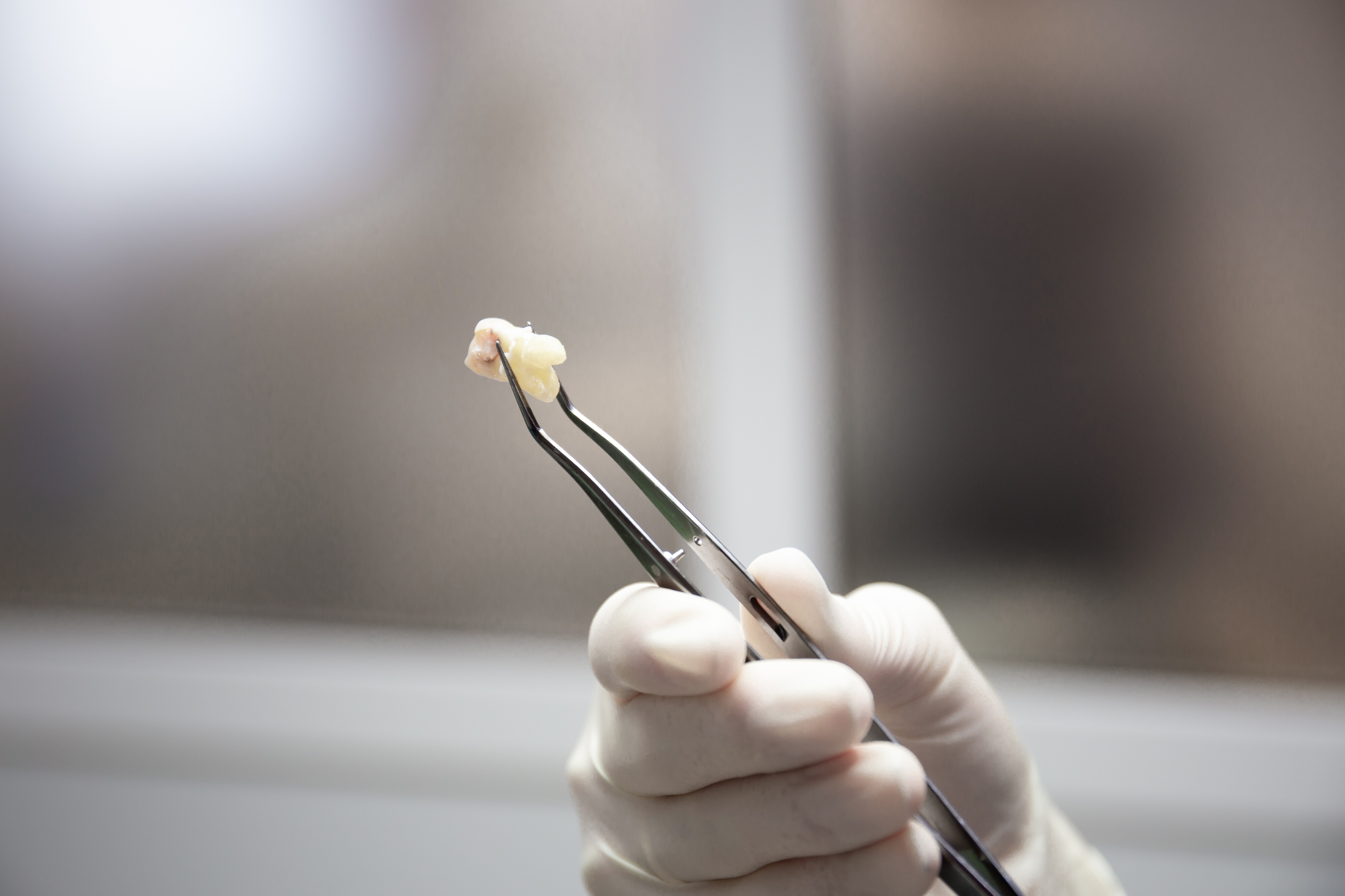 extração dente do siso