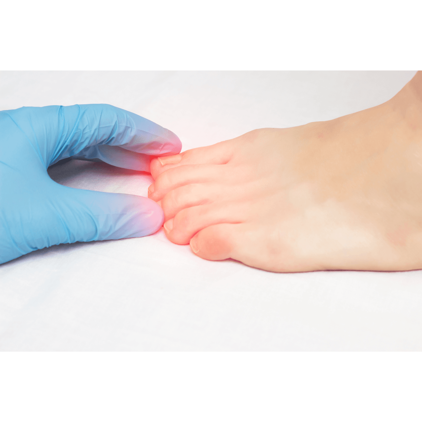 Ingrowing Nail 