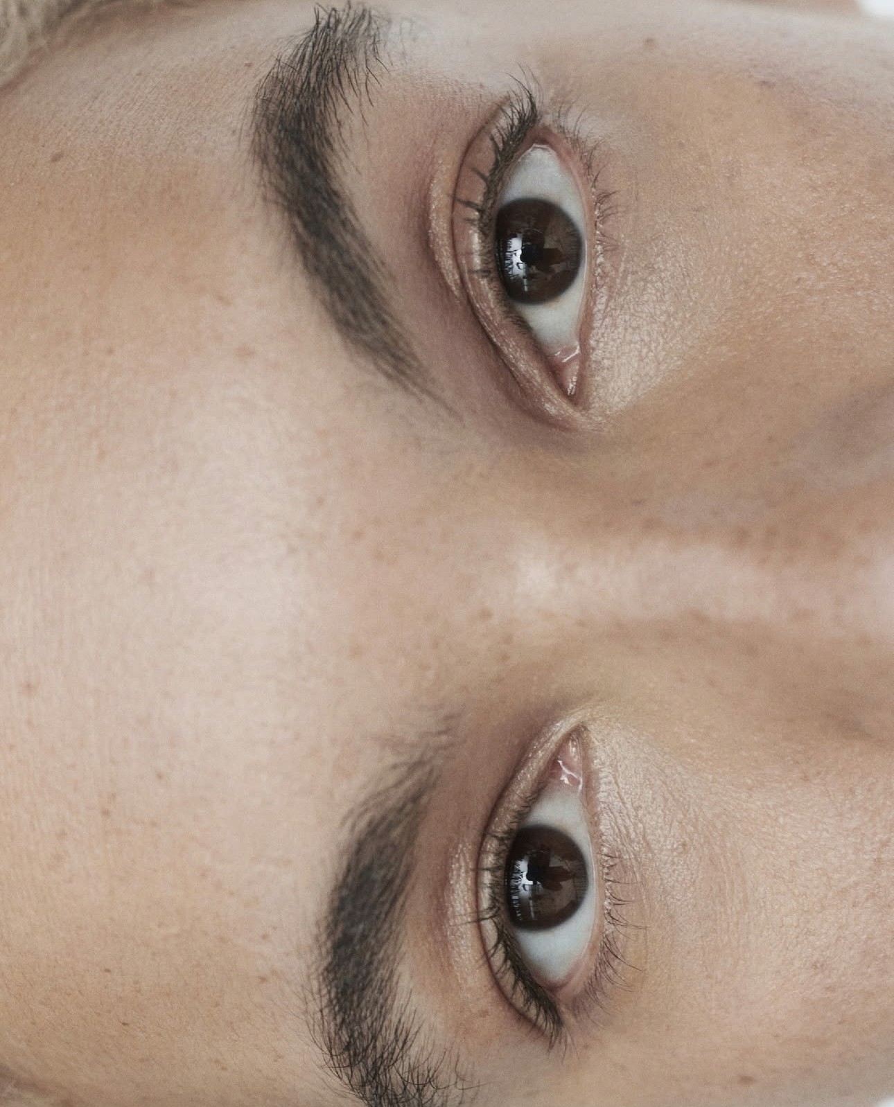 Glatte Stirn und Zornesfalte nach Botulinumtoxin-Behandlung in Bad Wörishofen Allgäu