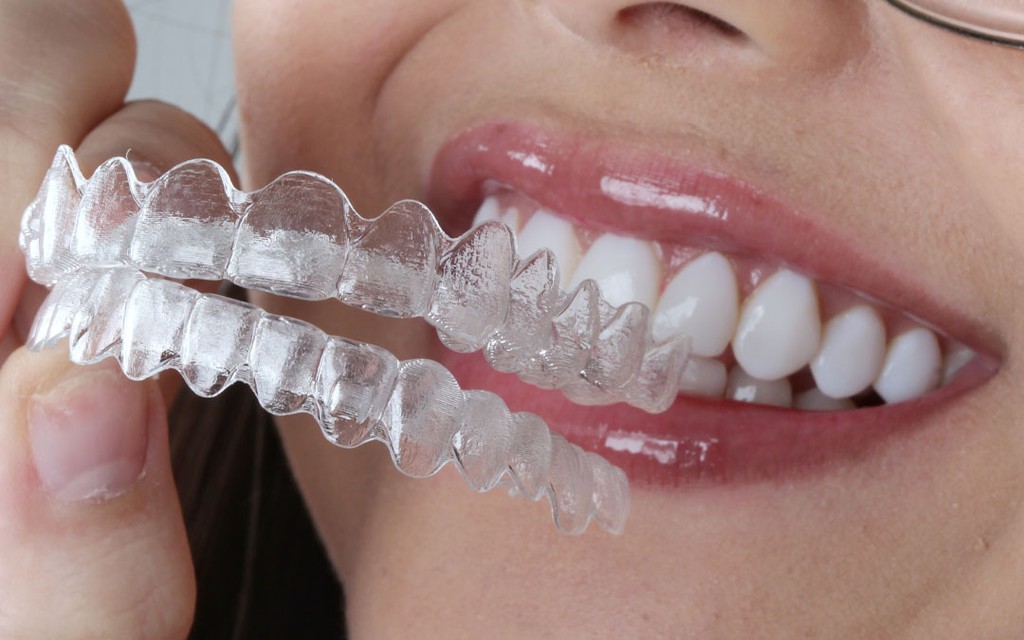 Invisalign vs braces
