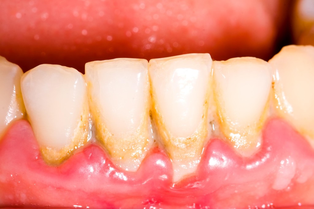 Dental Plaque
