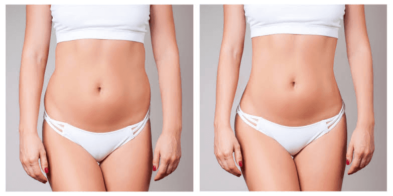 How Long Does Liposuction Last? Are the Results Permanent?