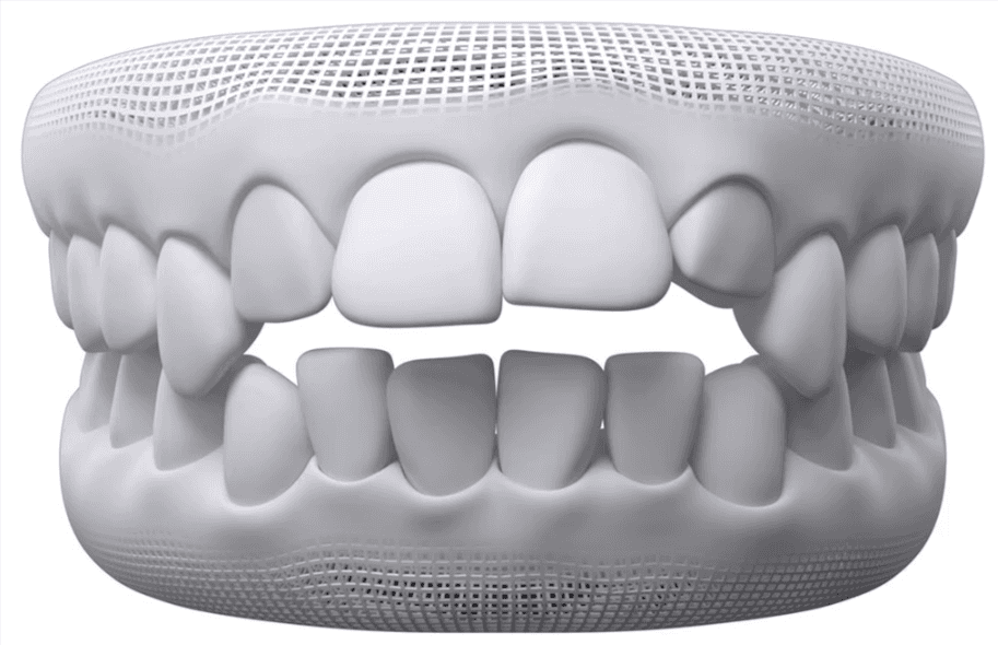 3D dental model showing bite misalignment linked to teeth grinding and uneven pressure on the jaw.&nbsp;