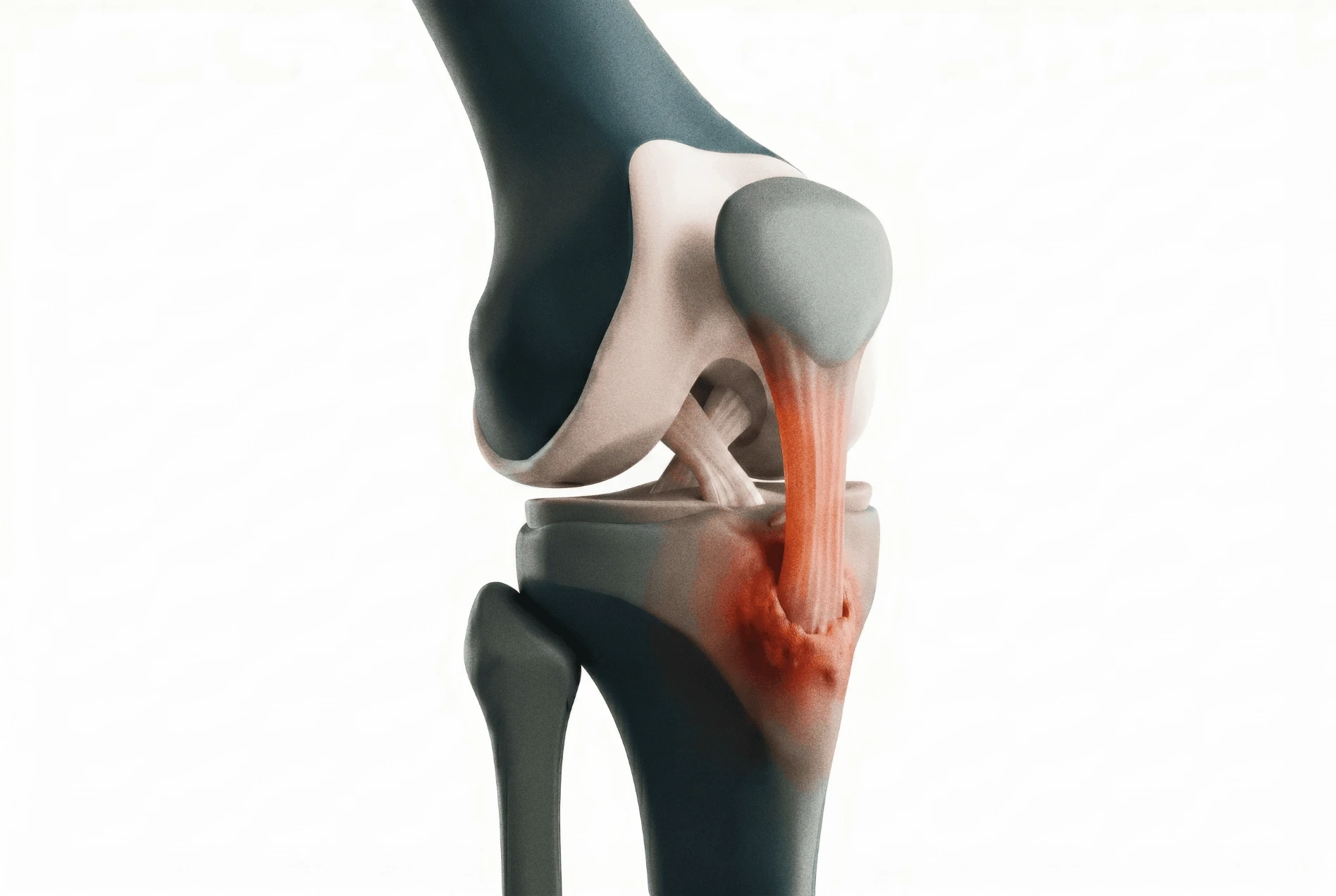 Child Osgood Schlatter