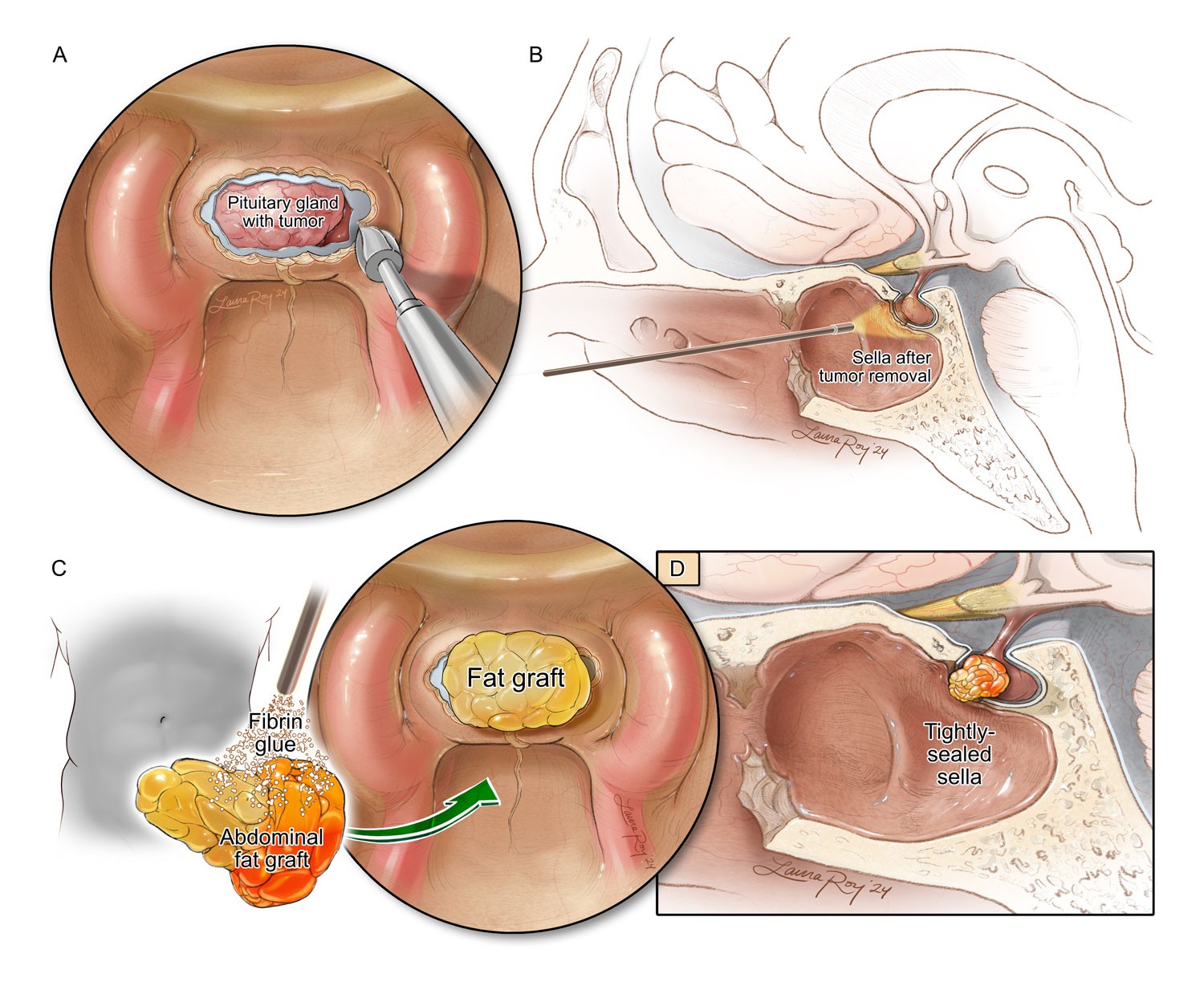 Crafted Abdominal Autologous Grafting