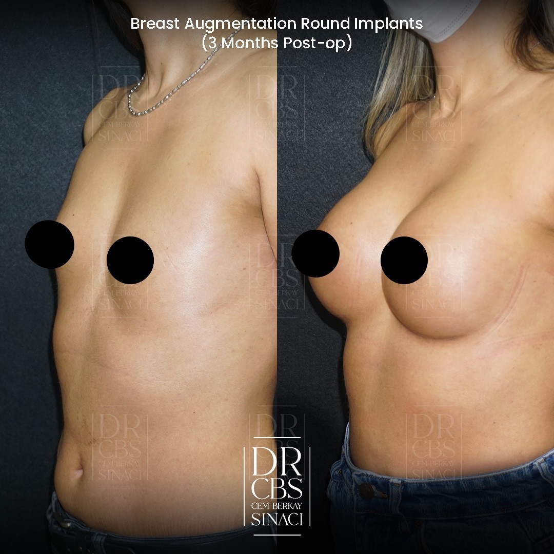 breast implant result 3 months oblique view