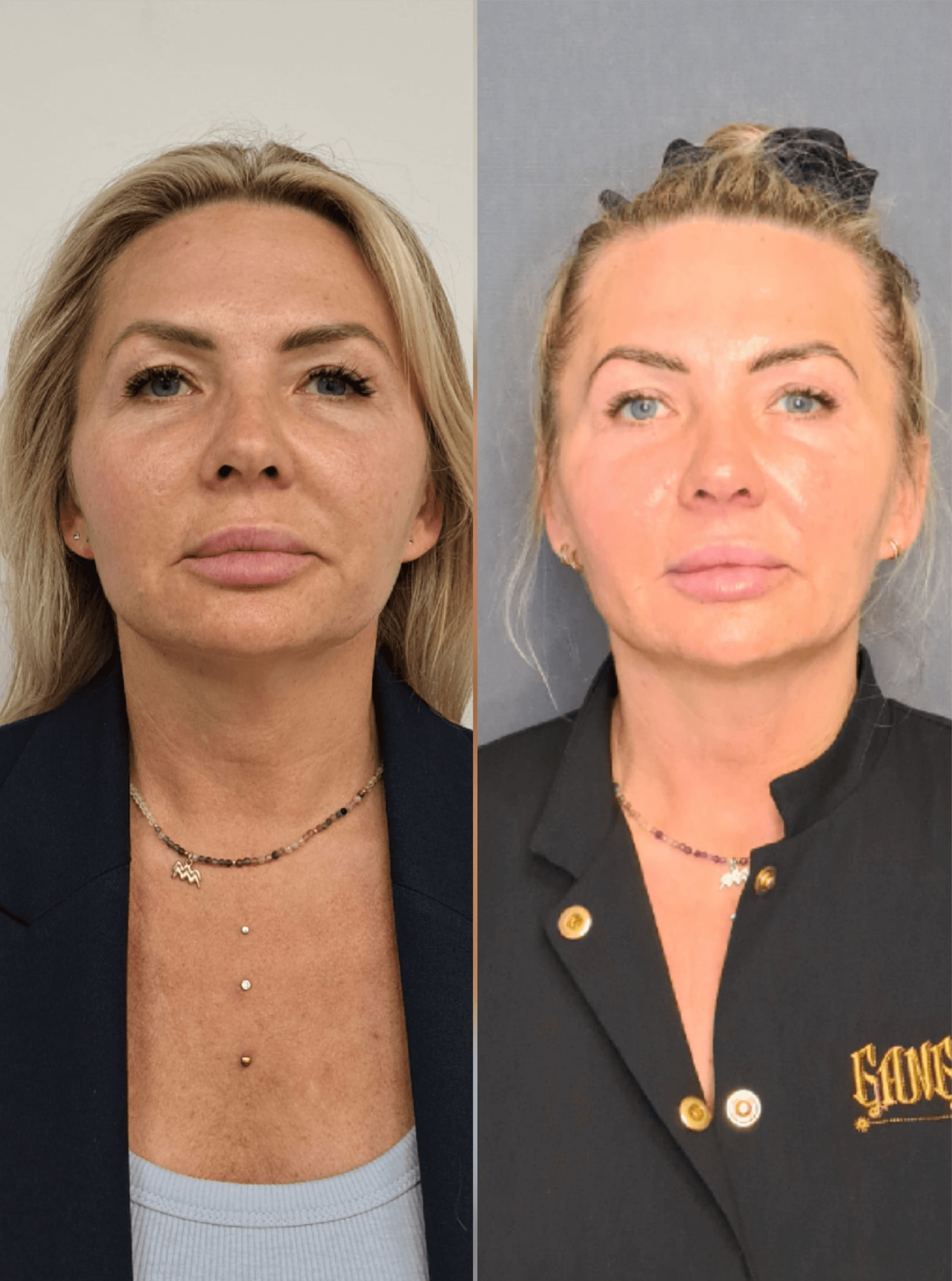 Neurolifting neurorehabiltacja_szczecin_wrocÅaw_efekt_trzech_zabiegoÌw_estGen_leszczenko