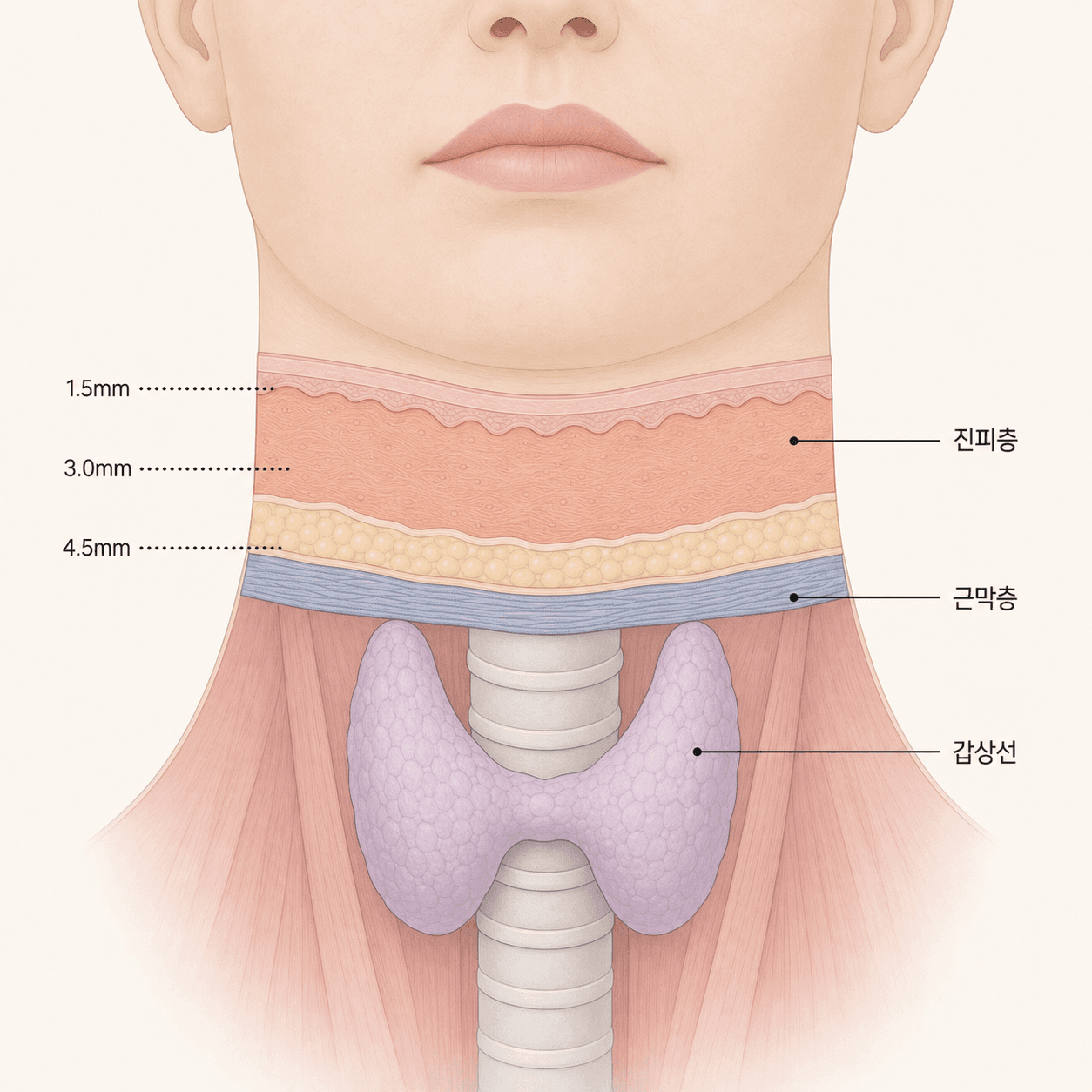 HIFU 집속 깊이와 갑상선 위치 관계