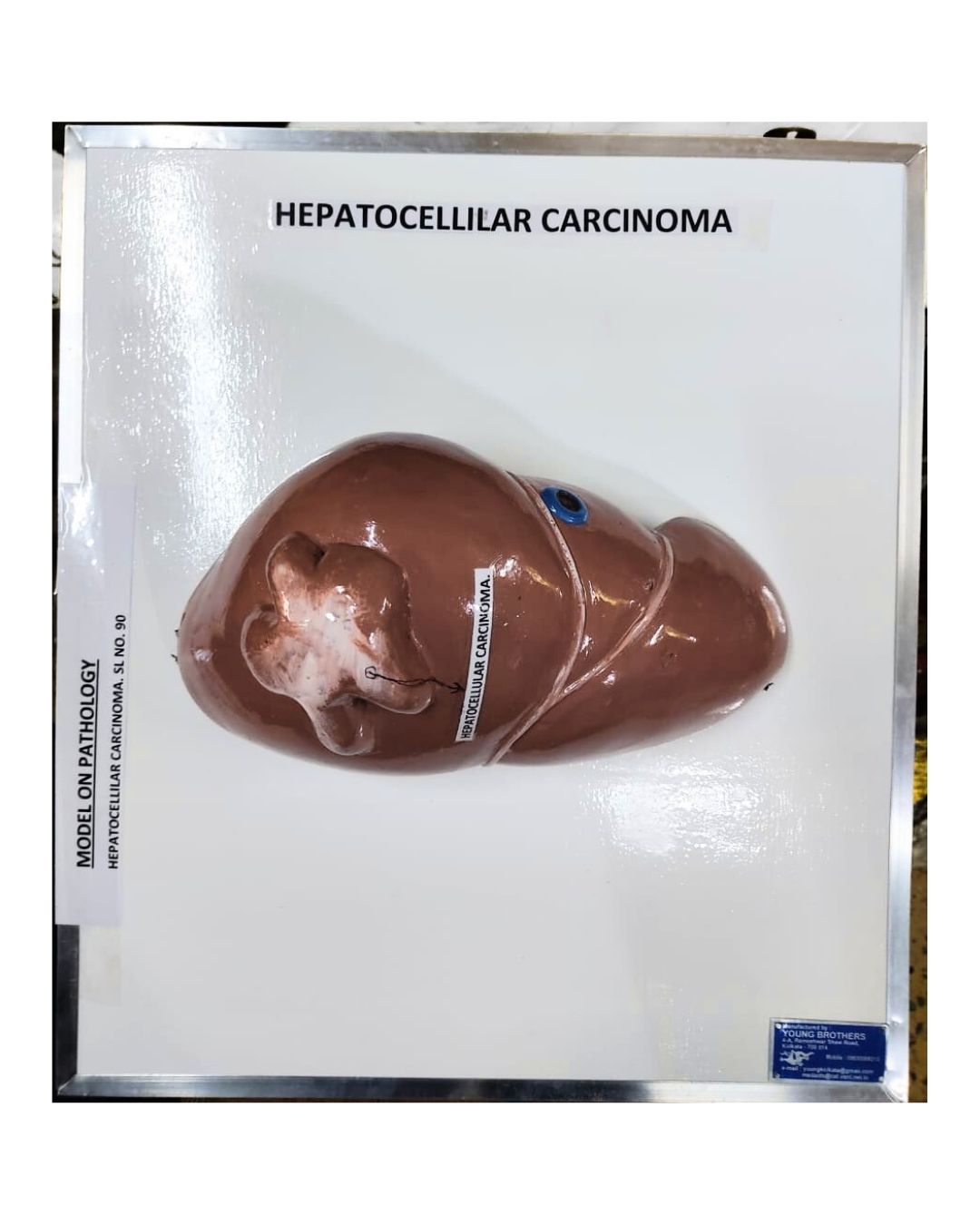 Hepatocellular Carcinoma Model