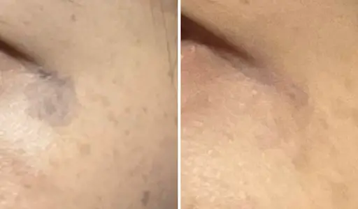 Toro pigmentation removal treatment before and after results.