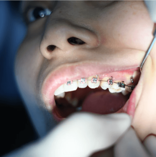 Nahaufnahme des Mundes einer Person während einer zahnärztlichen Untersuchung, auf der Zahnspangen und zahnärztliche Instrumente zu sehen sind.